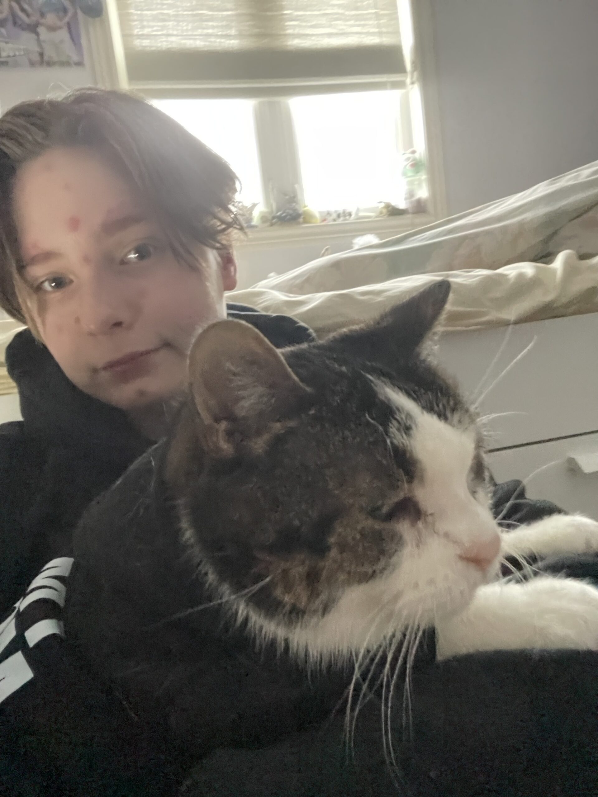 Alex resting at home during lupus flare-up while managing fatigue and visible lupus symptoms