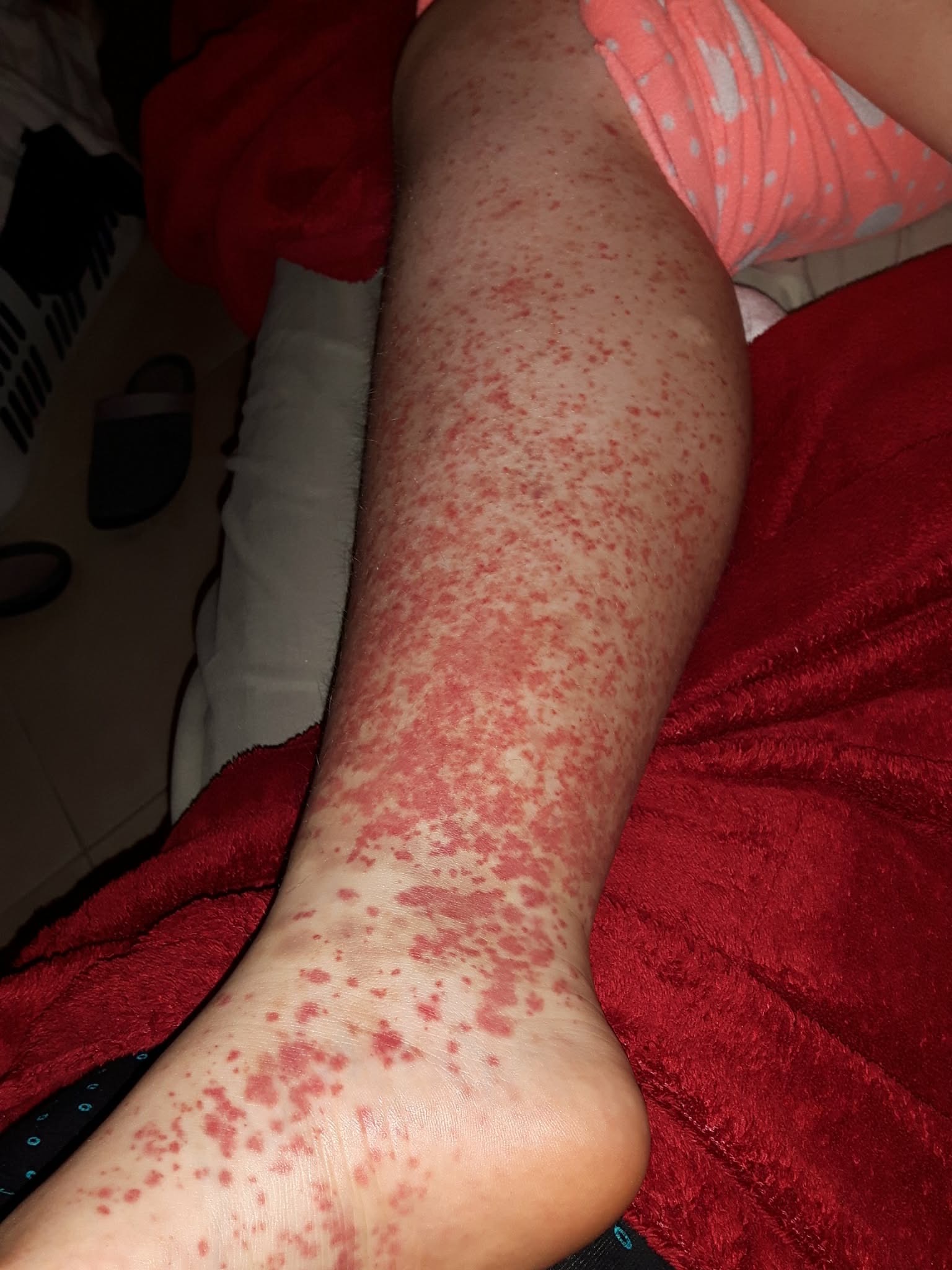 Alex sur le campus universitaire tout en affrontant les symptômes du lupus et ses études postsecondaires