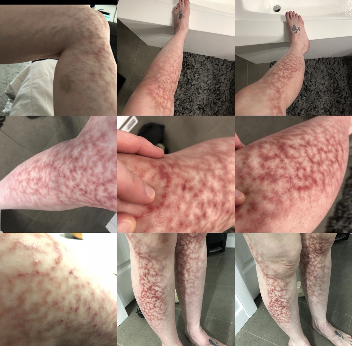 Vivre avec le lupus : L’histoire de Filomena montrant un livedo reticularis sur les jambes de Filomena Eremita lors des poussées de lupus.