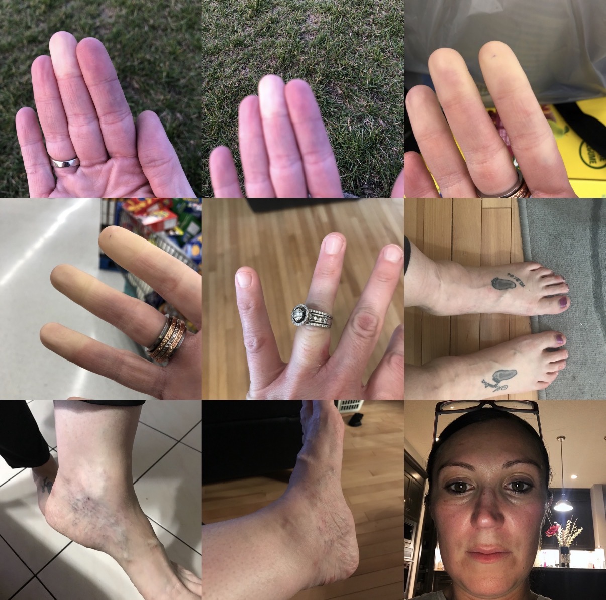 Vivre avec le lupus : L’histoire de Filomena montrant le syndrome de Raynaud, le gonflement et la rougeur du visage lors des poussées de lupus.