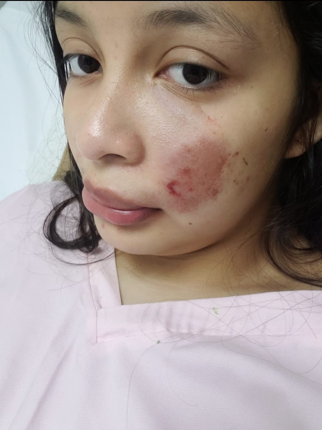 Alessandra documenting symptoms affecting her left cheek before her lupus diagnosis