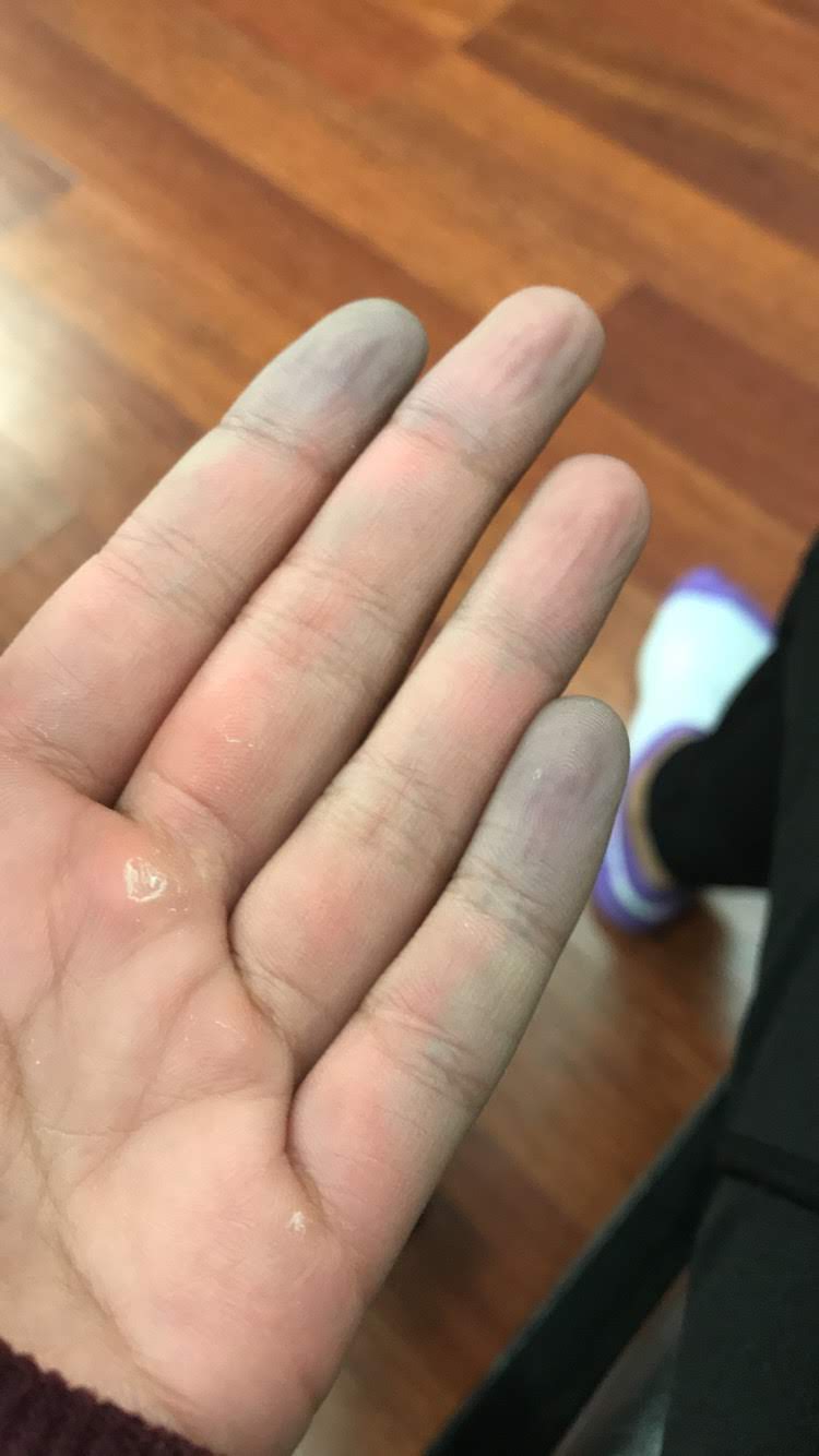 Gros plan de la main d’Eunice Tang montrant des doigts pâles et décolorés associés au syndrome de Raynaud.